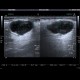 Pleomorphic adenoma of parotid gland: US - Ultrasound